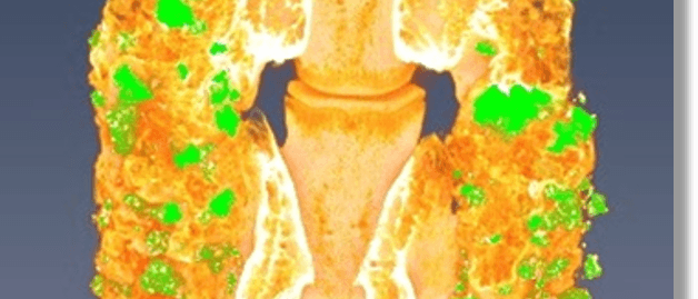 Bone Spinal Fusion (fusion “putty” [green] replaced by new bone)